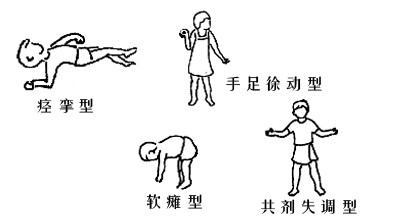 脑瘫最新分型,脑瘫新分类法介绍