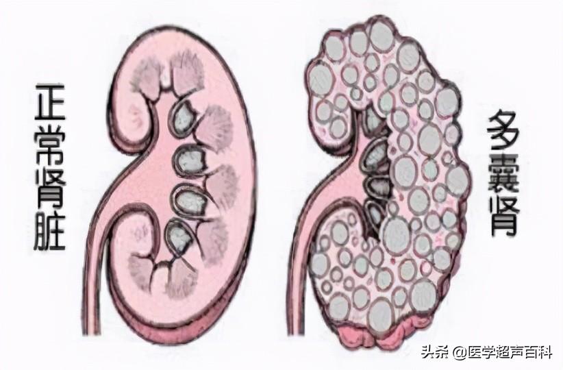 多囊肝多囊肾最新治疗｜多囊肝肾病治疗新进展